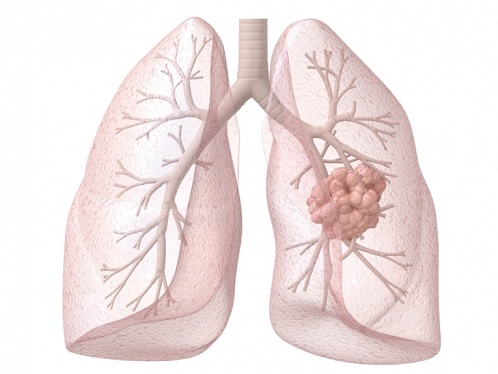 Plaušu vēzis